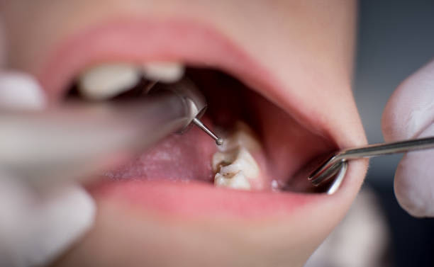 【歯科医師監修】子供にむし歯が！　その原因と治療、予防について