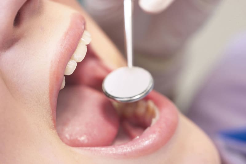 歯の「黒い点」は初期虫歯の可能性! できやすい場所や治療法を解説