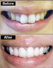 歯を強化する審美治療美と健康を追求する審美歯科（後編）