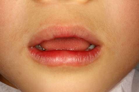 「お口ぽかん」歯科通院の子どもの3割　高年齢ほど割合高く　鹿児島大学病院など全国調査