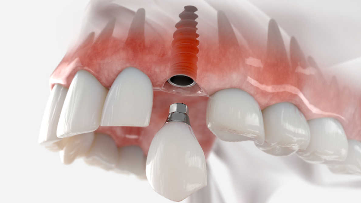 オーストラリアの研究者が歯科インプラントの治療成績の向上を目指す