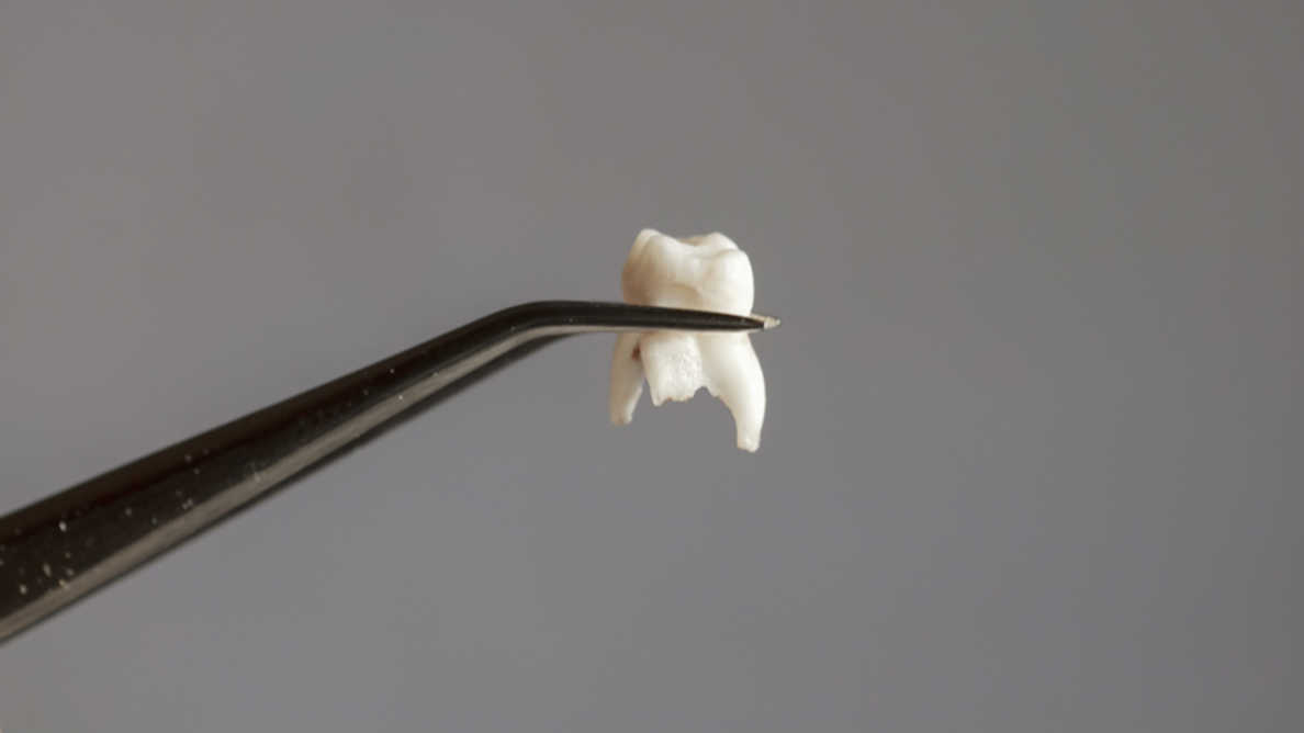 機械学習アルゴリズムが歯の喪失を予測するのに役立つかもしれない
