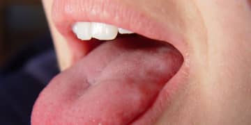 がん闘病で舌の半分を切除した女性　太ももの筋組織と皮膚を使用し再建に成功