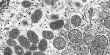 「サル痘」が世界に感染拡大！ ラクダ痘・天然痘の関係は…医療情報学教授が解説