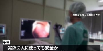 難病「潰瘍性大腸炎​」再生医療で難病克服を目指す世界初の試みを実施　東京医科歯科​大学