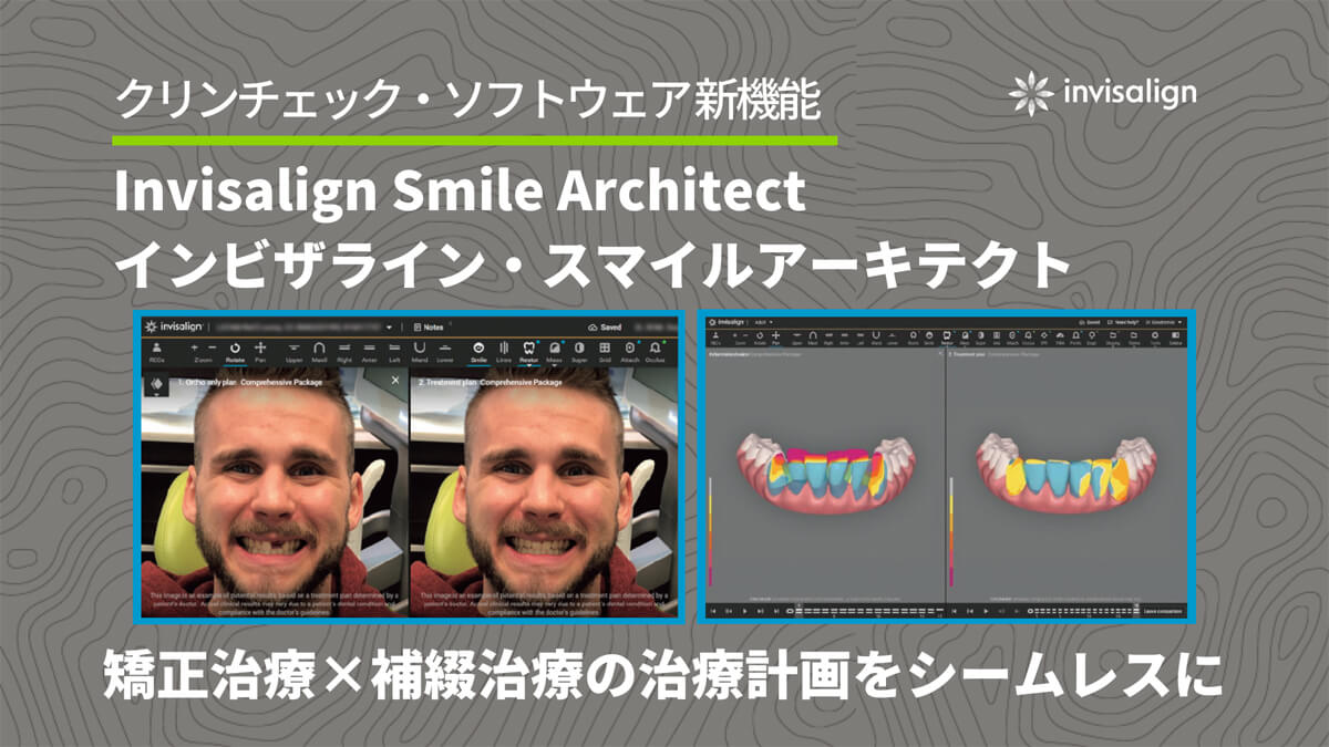 クリンチェック・ソフトウェア内の新機能のご紹介『Invisalign Smile Architect（インビザライン・スマイルアーキテクト』 ～矯正治療×補綴治療を一つの治療計画で～
