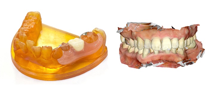【プレスリリース】＜デジタルでノンメタルクラスプ義歯製作＞口腔内スキャナーデータから少数歯欠損義歯の製造開始