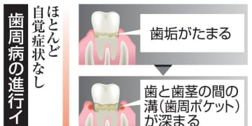 歯周病、簡易検査普及へ開発支援　厚労省、口内健康が全身にも影響