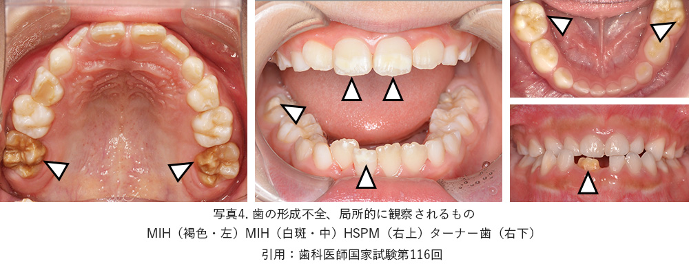 出典：日本小児歯科学会