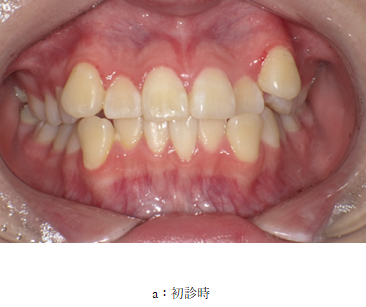 【プレスリリース】日本人に最適化した歯列矯正治療法「JET system」により、7か月で治療完了 ～効率的な治療法と結果を7月13日東京矯正歯科学会で発表～