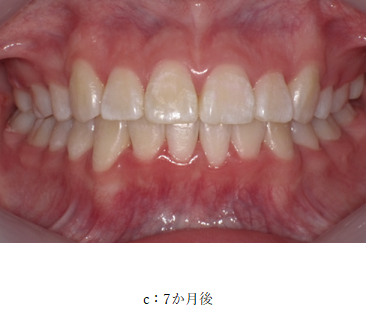 【プレスリリース】日本人に最適化した歯列矯正治療法「JET system」により、7か月で治療完了 ～効率的な治療法と結果を7月13日東京矯正歯科学会で発表～