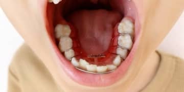 【調査報告】歯列矯正経験者の8割以上が歯列矯正は想定していたよりも大変だった！その原因は？