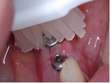 歯頸部を磨きやすい幅の狭いタイプ