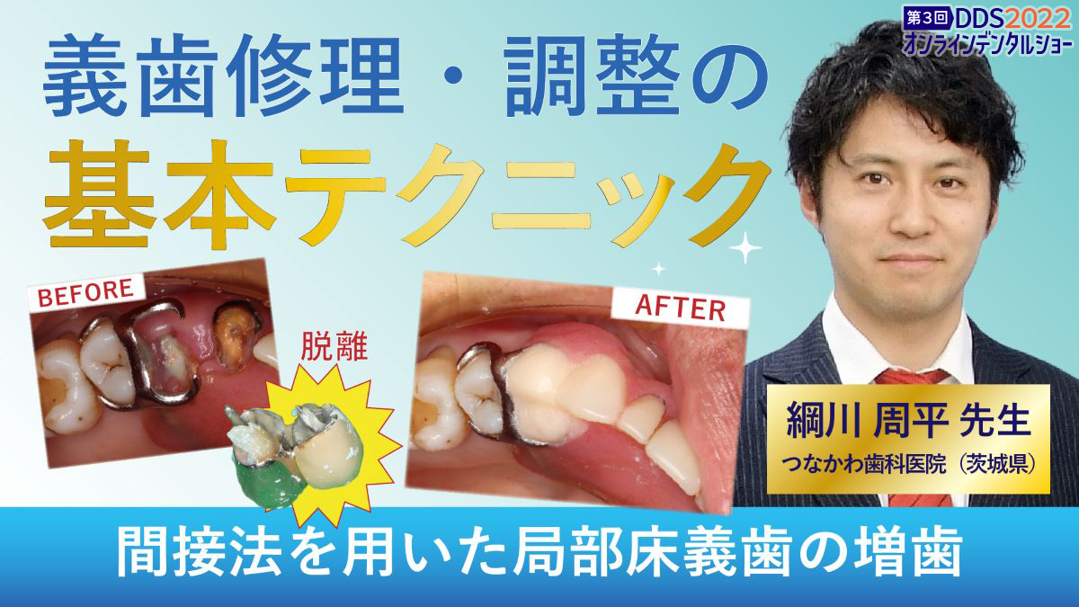義歯修理・調整の基本テクニック　間接法を用いた局部床義歯の増歯